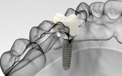 Impianti dentali fanno male? Cosa si prova davvero, prima, durante e dopo