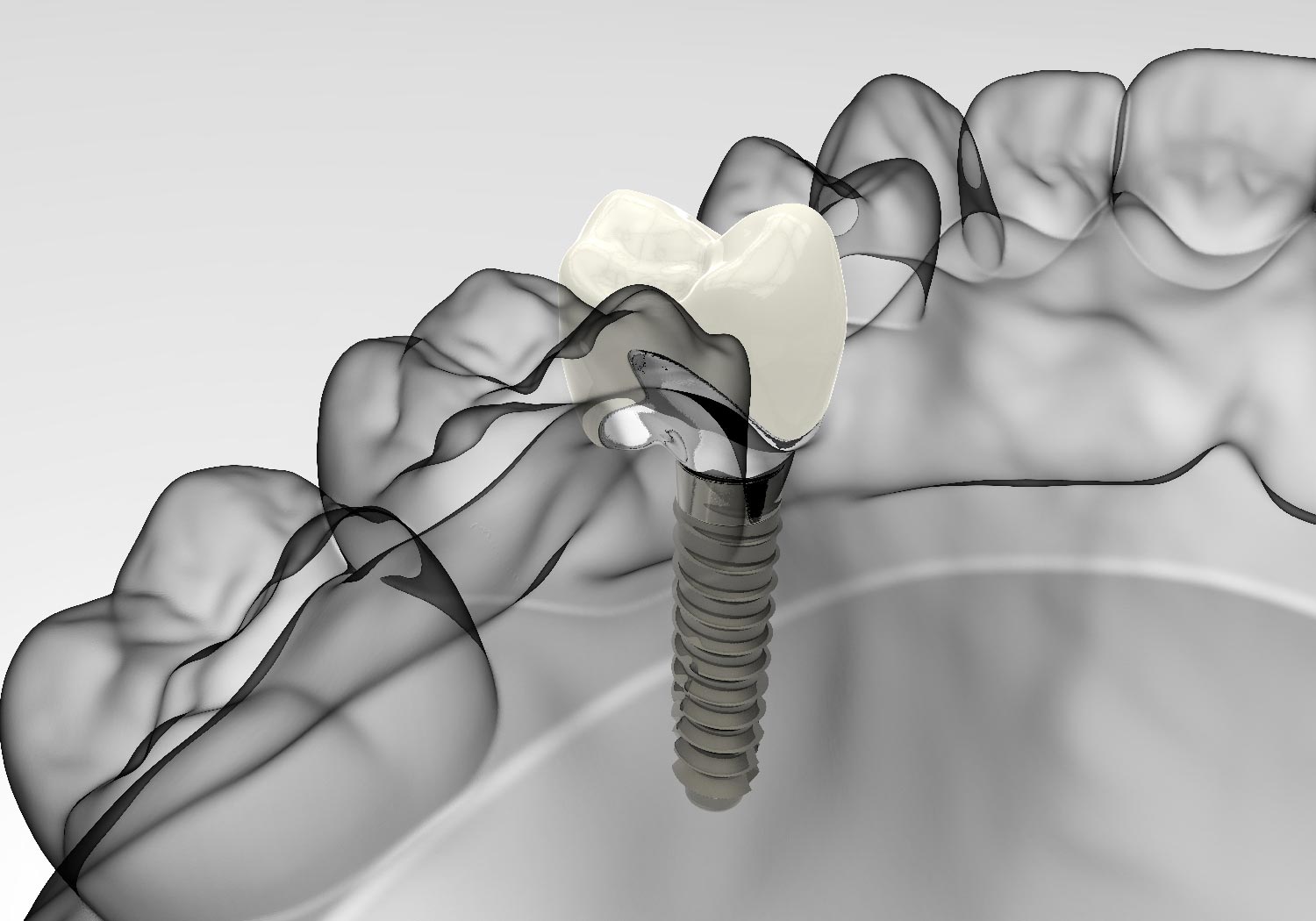 Impianti dentali fanno male - LM Dental Clinic