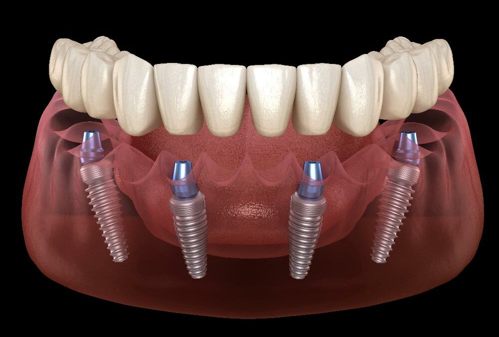 Denti fissi in un giorno: è davvero possibile? Come funziona il carico immediato