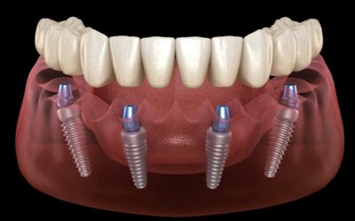 Denti fissi in un giorno: è davvero possibile? Come funziona il carico immediato