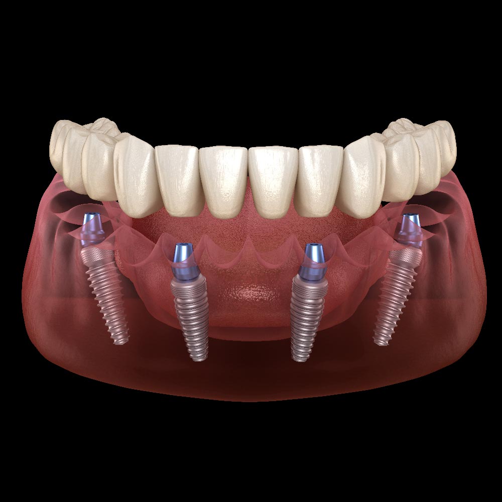 Denti fissi in un giorno Denti fissi in un giorno - LM Dental Clinic