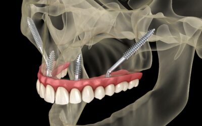 Chi non può fare impianti dentali? Falsi miti e reali limitazioni