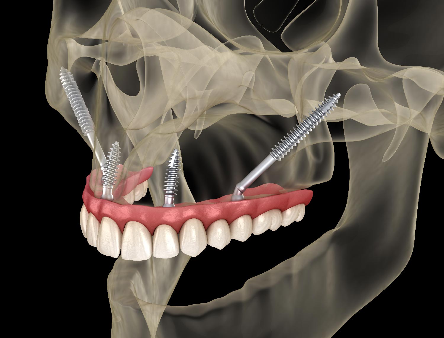 Chi non può fare impianti dentali Chi non può fare impianti dentali - LM Dental Clinic